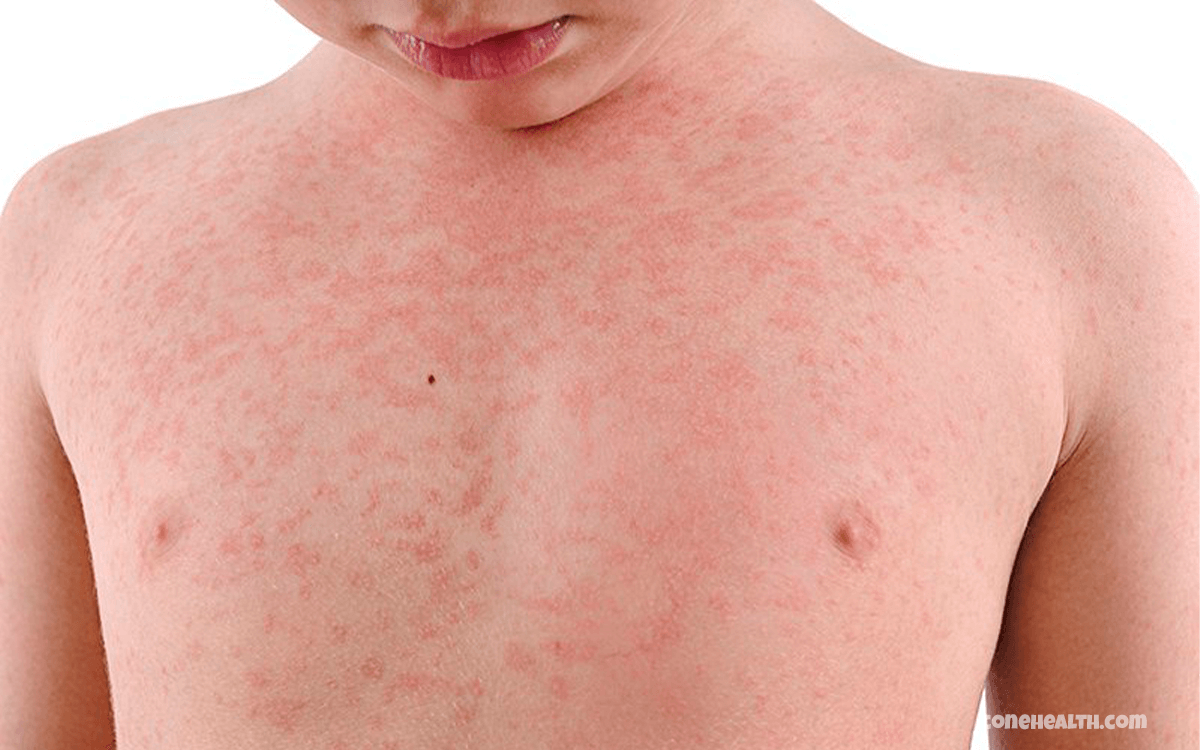 Measles - Top 10 Worst Pandemics In History