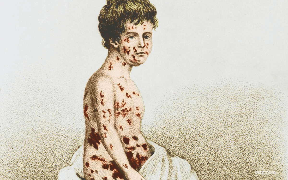 Smallpox - Top 10 Worst Pandemics In History