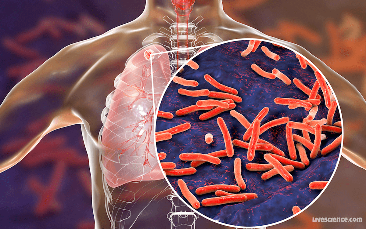 Tuberculosis - Top 10 Worst Pandemics In History